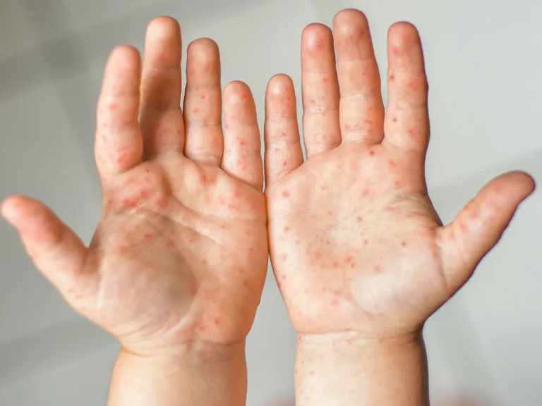 สังเกตรู้ทัน ป้องกัน มือ เท้า ปาก