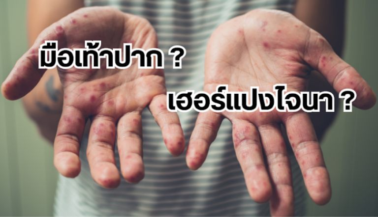 มือเท้าปาก เฮอร์แปงไจนา